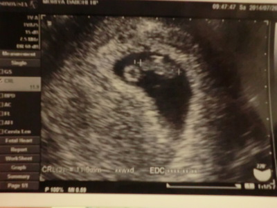 初めての胎児のエコー写真(*ω*)